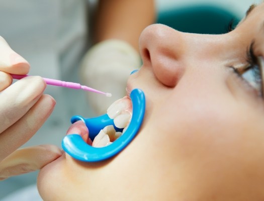 Close up of child receiving silver diamine fluoride