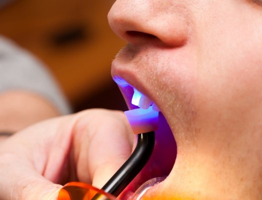 Close up of cosmetic bonding being performed on upper teeth