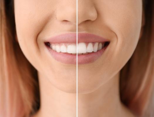 Smile before and after gum recontouring