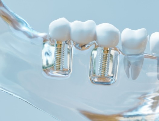 Close up of dental bridge and dental implants in plastic tray