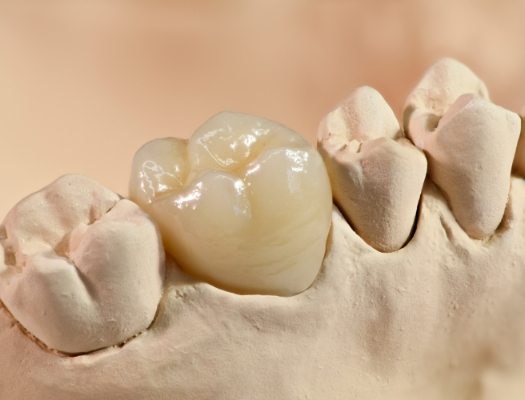 Close up of dental crown in mold of teeth