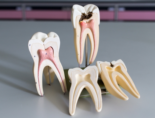 Multiple models showing inside of tooth